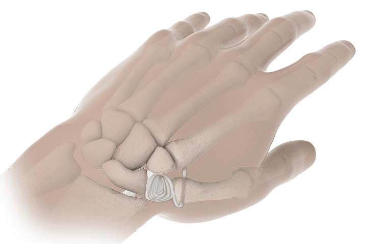 basal thumb arthritis treatment