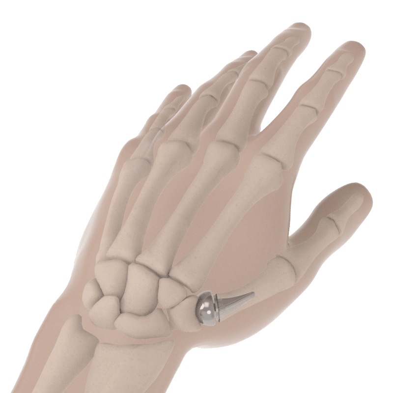 Modular Thumb Implant | Arthritis of the Thumb